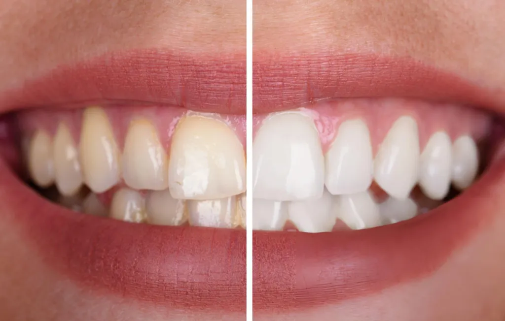 Teeth Whitening